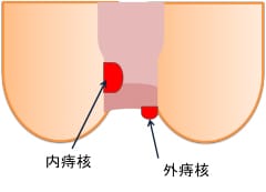 内痔核、外痔核